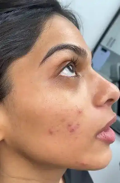Before using Kinure kit