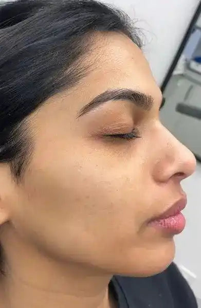 After using Kinure kit